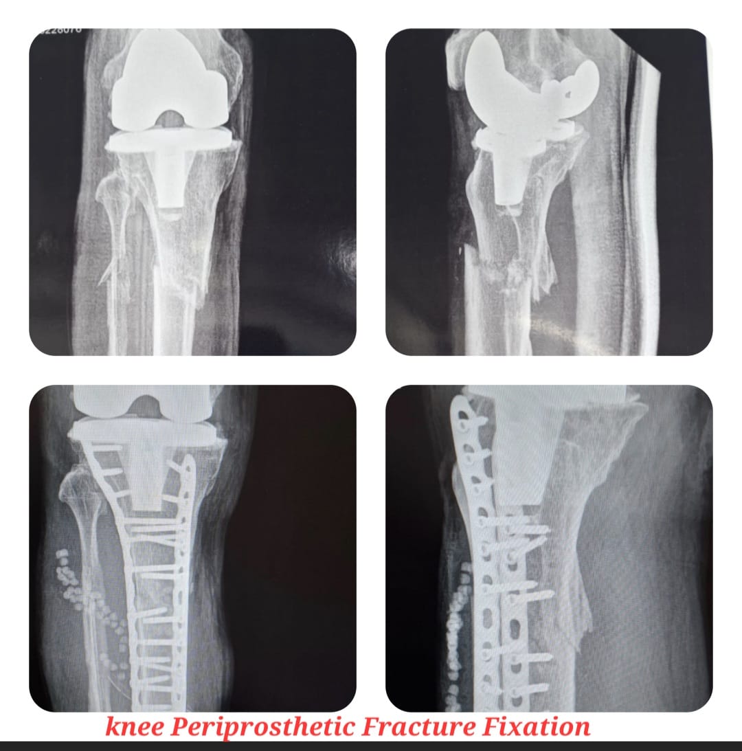 Knee X-ray 6